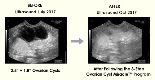 Ovarian Cyst Miracle™ - OFFICIAL WEBSITE - Heal Ovarian Cysts and PCOS